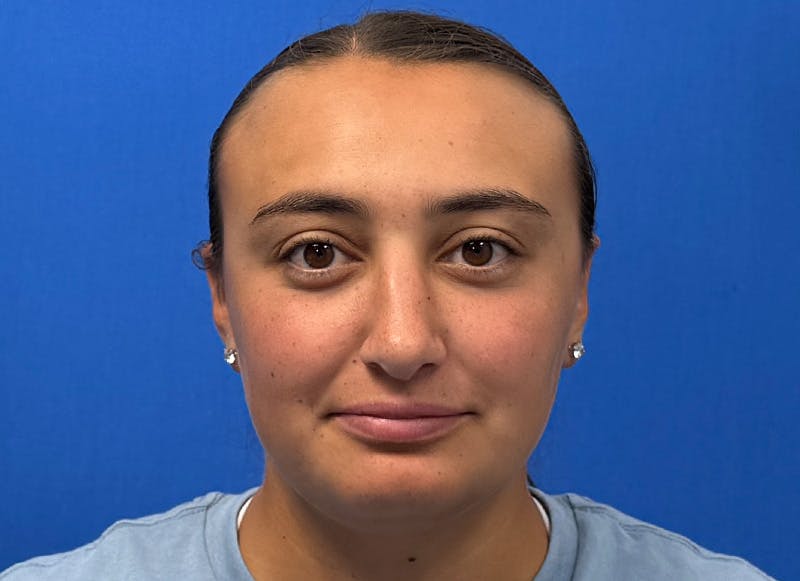 Rhinoplasty Before & After Gallery - Patient 445507 - Image 6