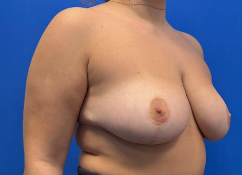 Breast Reduction Before & After Gallery - Patient 294917 - Image 8