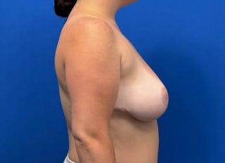 Breast Reduction Before & After Gallery - Patient 345901 - Image 10