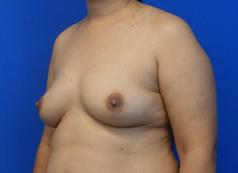 Flap Reconstruction Gallery Before & After Gallery - Patient 319108 - Image 3