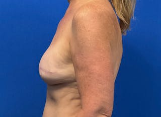 Flap Reconstruction Gallery Before & After Gallery - Patient 410362 - Image 2