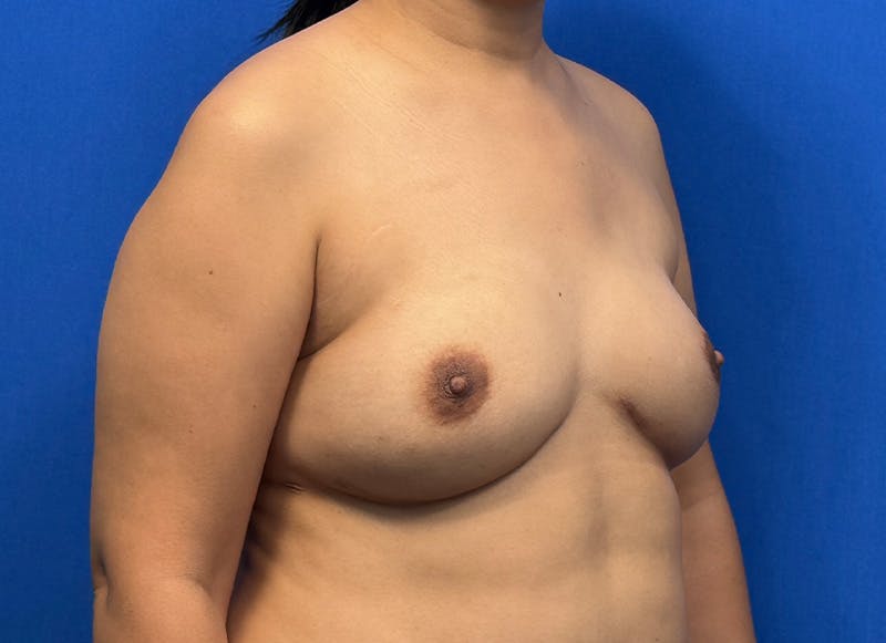 Flap Reconstruction Gallery Before & After Gallery - Patient 319108 - Image 8