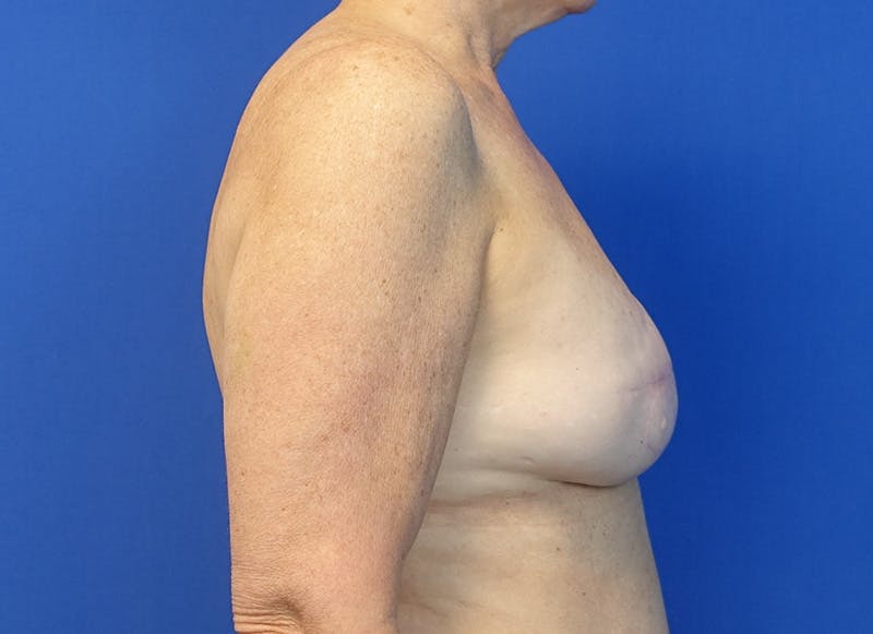 Flap Reconstruction Gallery Before & After Gallery - Patient 410362 - Image 9