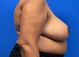 Breast Reduction Before & After Gallery - Patient 396023 - Image 10