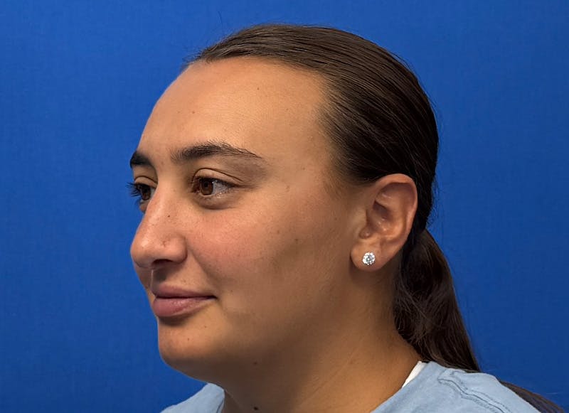 Rhinoplasty Before & After Gallery - Patient 445507 - Image 4