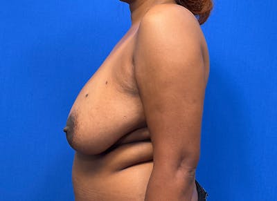 Breast Lift Before & After Gallery - Patient 362576 - Image 1