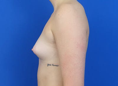 Implant Reconstruction Gallery Before & After Gallery - Patient 358081 - Image 1