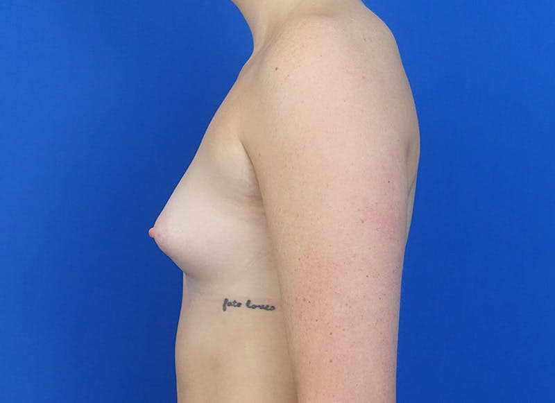 Implant Reconstruction Gallery Before & After Gallery - Patient 358081 - Image 1