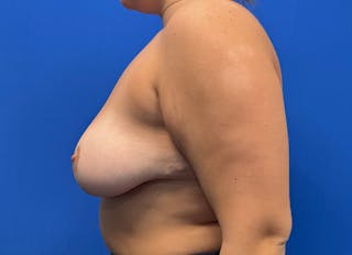 Breast Reduction Before & After Gallery - Patient 294917 - Image 2