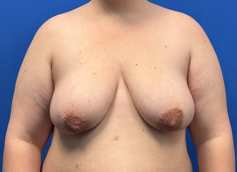 Breast Lift Before & After Gallery - Patient 981827 - Image 5