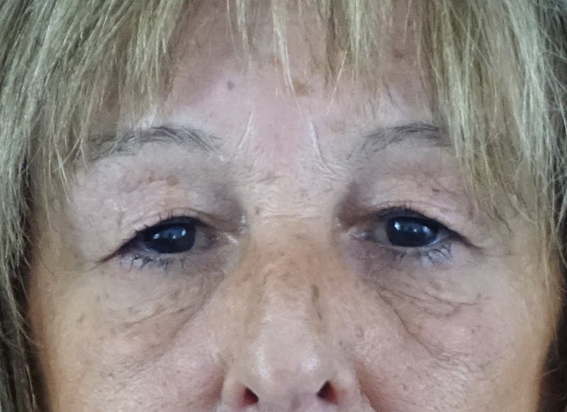 Blepharoplasty Before & After Gallery - Patient 253186 - Image 1