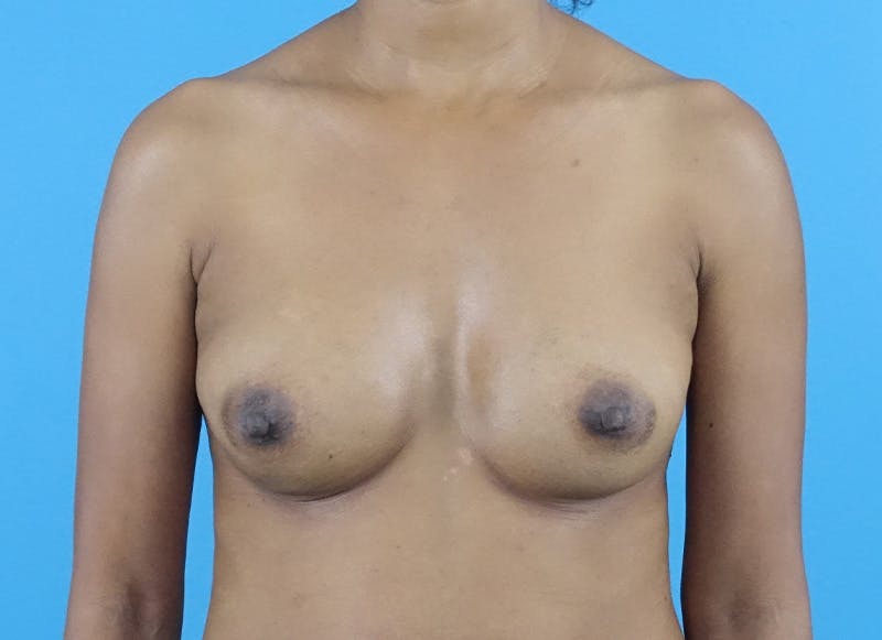 Hybrid Reconstruction Gallery Before & After Gallery - Patient 119418 - Image 5