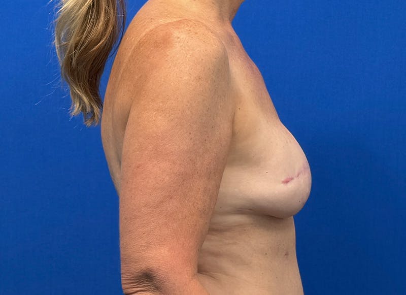 Flap Reconstruction Gallery Before & After Gallery - Patient 410362 - Image 10
