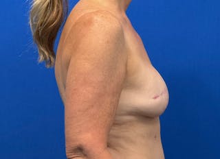 Flap Reconstruction Gallery Before & After Gallery - Patient 410362 - Image 10