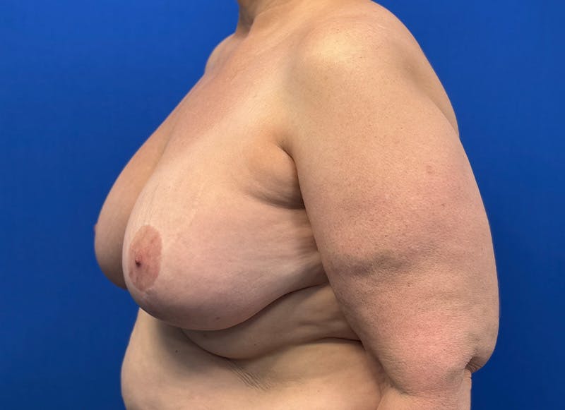 Implant Removal Before & After Gallery - Patient 350082 - Image 3