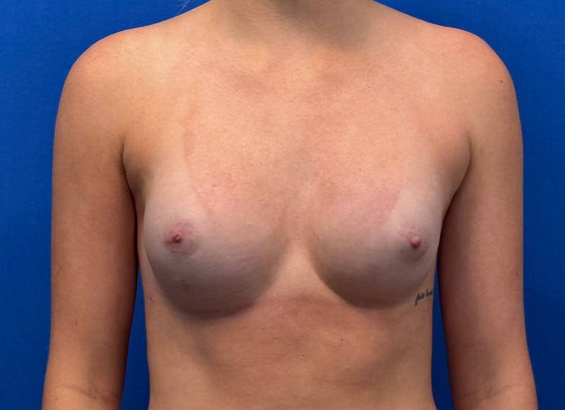 Implant Reconstruction Gallery Before & After Gallery - Patient 358081 - Image 6