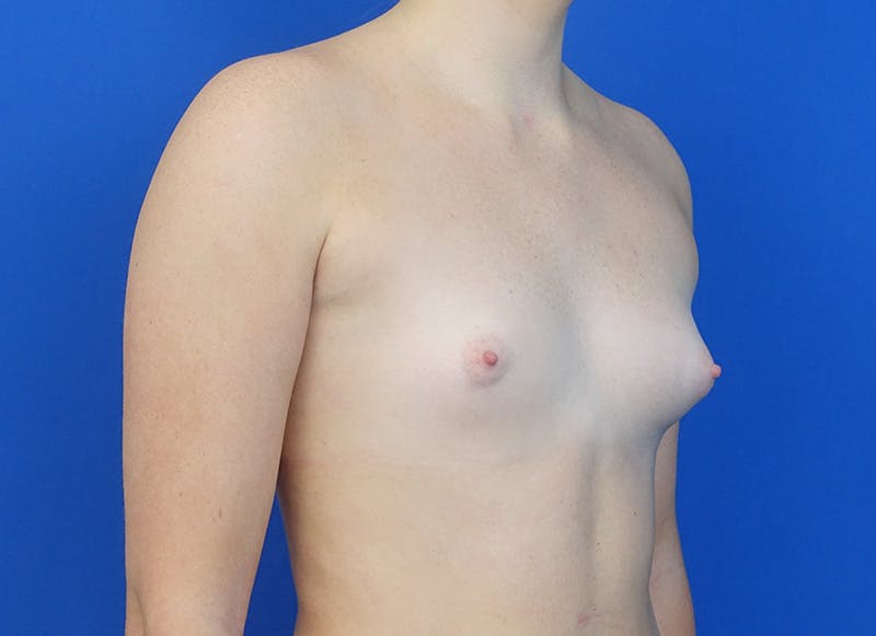 Implant Reconstruction Gallery Before & After Gallery - Patient 358081 - Image 7