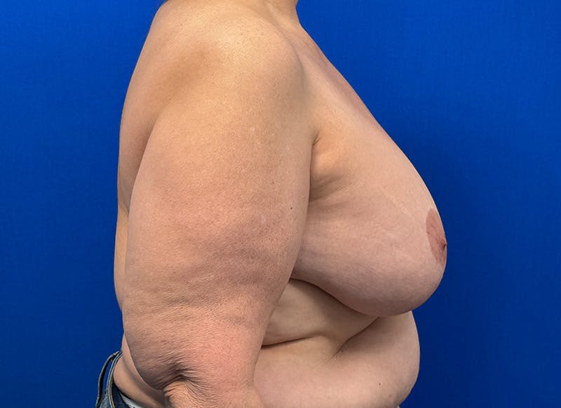 Breast Lift Before & After Gallery - Patient 415268 - Image 10
