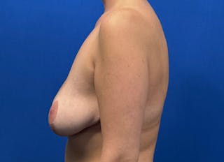 Breast Reduction Before & After Gallery - Patient 199695 - Image 2