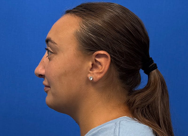 Rhinoplasty Before & After Gallery - Patient 445507 - Image 2