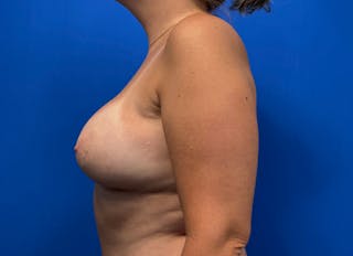 Hybrid Reconstruction Gallery Before & After Gallery - Patient 816392 - Image 2