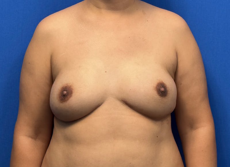 Flap Reconstruction Gallery Before & After Gallery - Patient 319108 - Image 6
