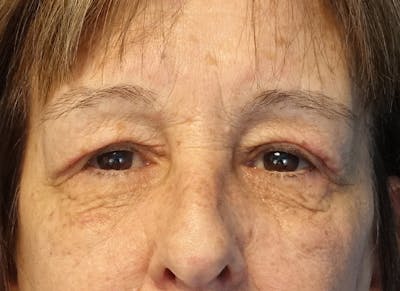 Blepharoplasty Before & After Gallery - Patient 253186 - Image 2