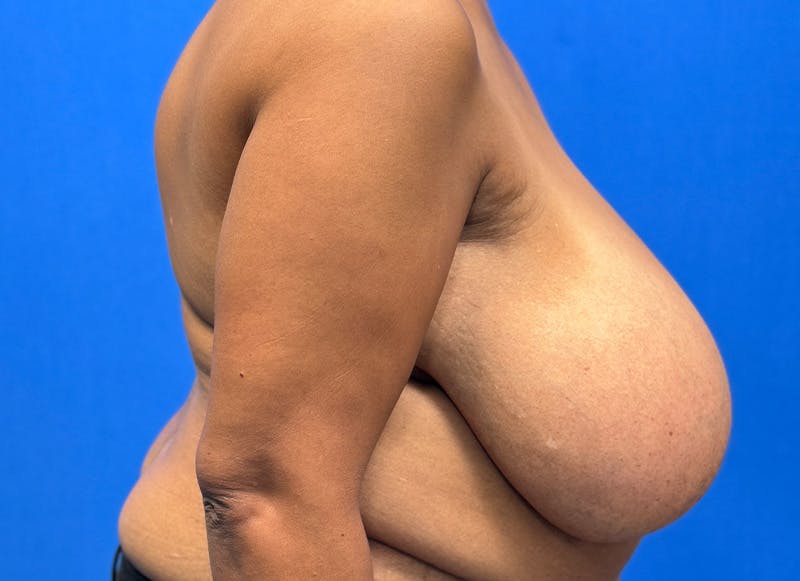 Breast Reduction Before & After Gallery - Patient 396023 - Image 9