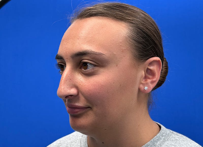 Rhinoplasty Before & After Gallery - Patient 445507 - Image 3