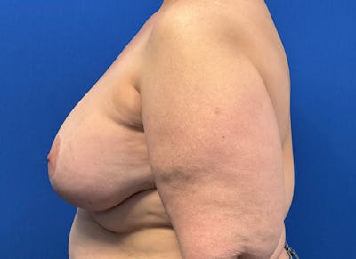 Implant Removal Before & After Gallery - Patient 350082 - Image 1