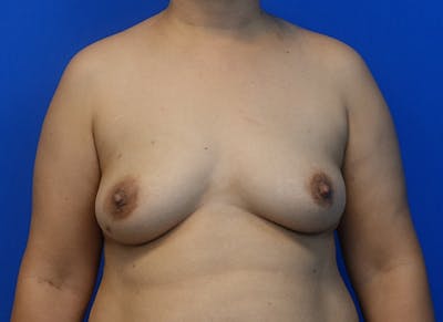 Flap Reconstruction Gallery Before & After Gallery - Patient 319108 - Image 5