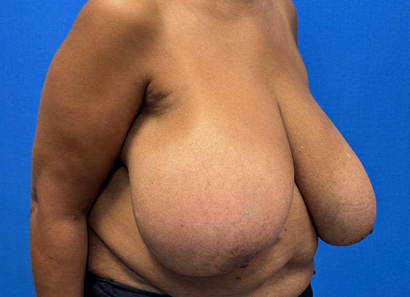 Breast Reduction Before & After Gallery - Patient 396023 - Image 7