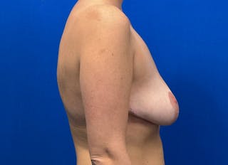Breast Reduction Before & After Gallery - Patient 199695 - Image 10