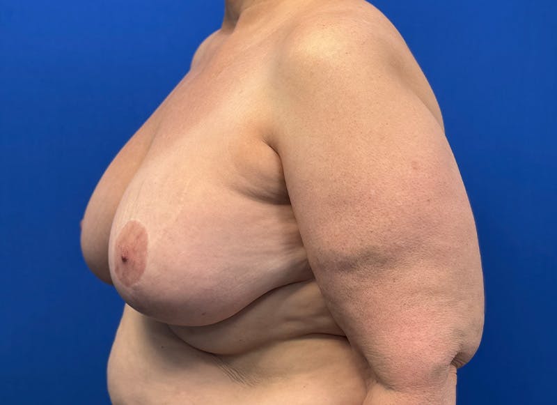 Breast Lift Before & After Gallery - Patient 415268 - Image 4