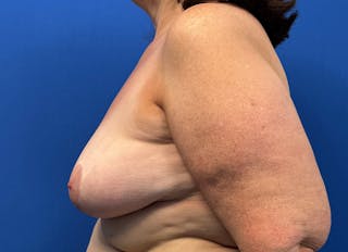 Implant Removal Before & After Gallery - Patient 350082 - Image 2