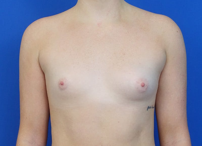 Implant Reconstruction Gallery Before & After Gallery - Patient 358081 - Image 5
