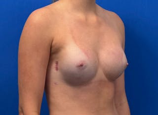 Implant Reconstruction Gallery Before & After Gallery - Patient 358081 - Image 8