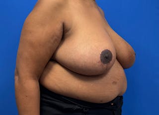 Breast Reduction Before & After Gallery - Patient 396023 - Image 8