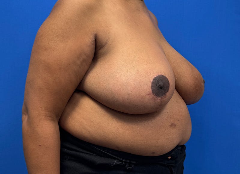Breast Reduction Before & After Gallery - Patient 396023 - Image 8