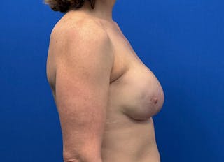 Implant Reconstruction Gallery Before & After Gallery - Patient 443329 - Image 10