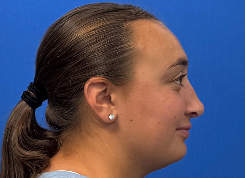 Rhinoplasty Before & After Gallery - Patient 445507 - Image 10