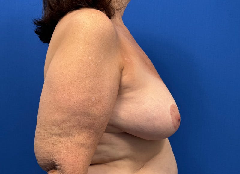 Implant Removal Before & After Gallery - Patient 350082 - Image 10