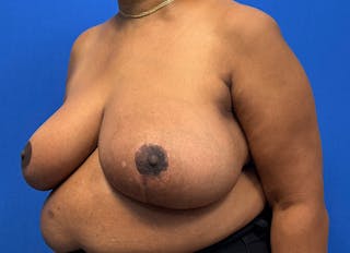 Breast Reduction Before & After Gallery - Patient 396023 - Image 4