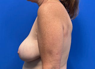 Breast Reduction Before & After Gallery - Patient 382207 - Image 2
