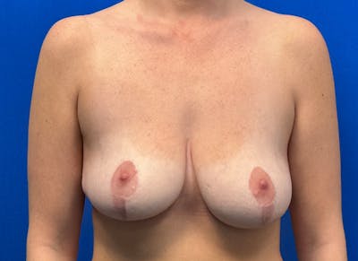 Breast Reduction Before & After Gallery - Patient 199695 - Image 6