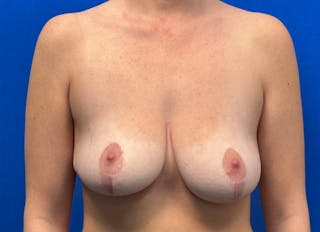 Breast Reduction Before & After Gallery - Patient 199695 - Image 6