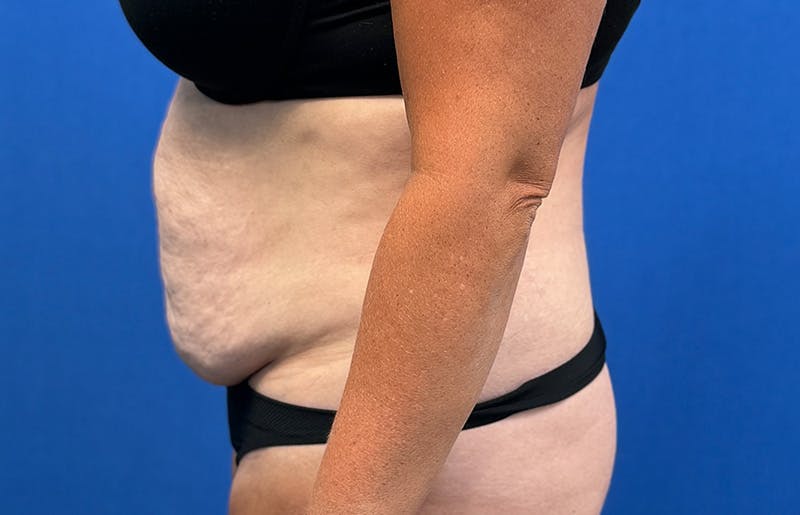 Abdominoplasty Before & After Gallery - Patient 352301 - Image 1