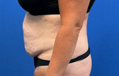 Abdominoplasty Before & After Gallery - Patient 352301 - Image 1