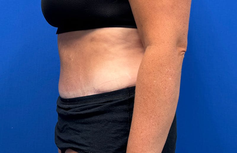 Abdominoplasty Before & After Gallery - Patient 352301 - Image 2