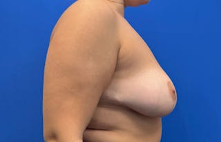 Breast Reduction Before & After Gallery - Patient 294917 - Image 10
